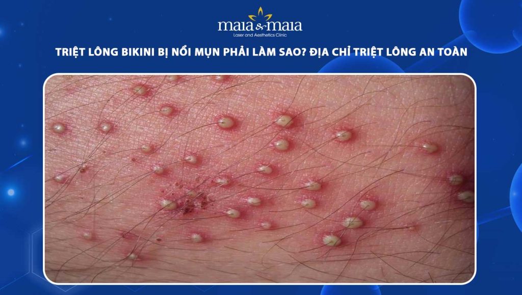 triệt lông bikini bị nổi mụn