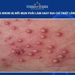 triệt lông bikini bị nổi mụn