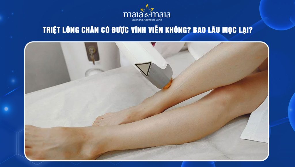 triệt lông chân có được vĩnh viễn không