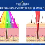 triệt lông diode laser và ipl