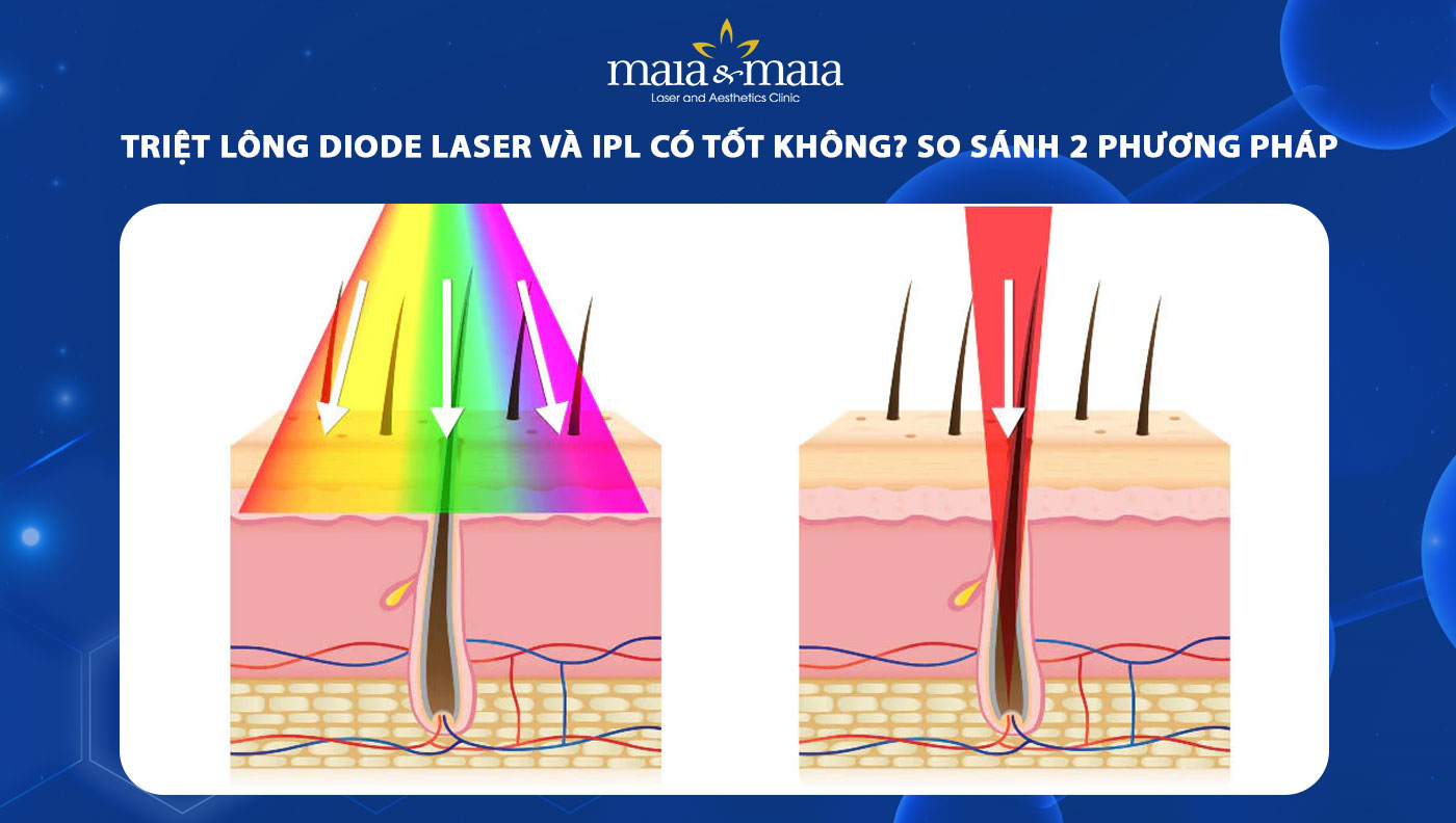 triệt lông diode laser và ipl