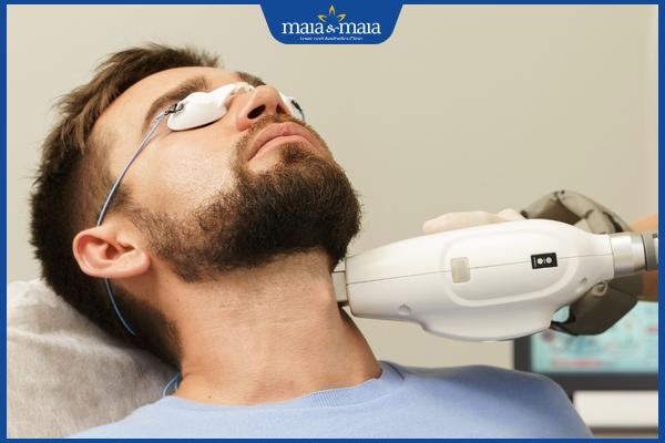 3 phương pháp triệt lông mặt vĩnh viễn cho nam hiệu quả, an toàn 3 triệt lông mặt IPL cho nam