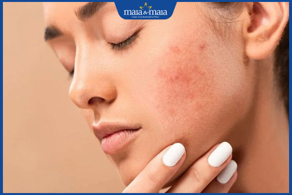 triệt lông mặt nổi mụn