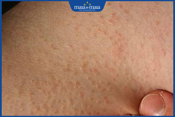 viêm lỗ chân lông