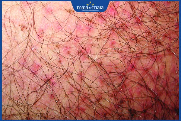 vùng kín viêm nang lông