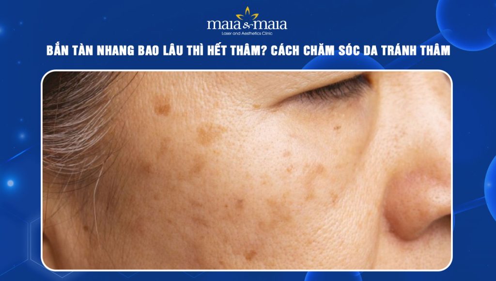 bắn tàn nhang bao lâu thì hết thâm