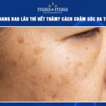 bắn tàn nhang bao lâu thì hết thâm