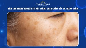 bắn tàn nhang bao lâu thì hết thâm