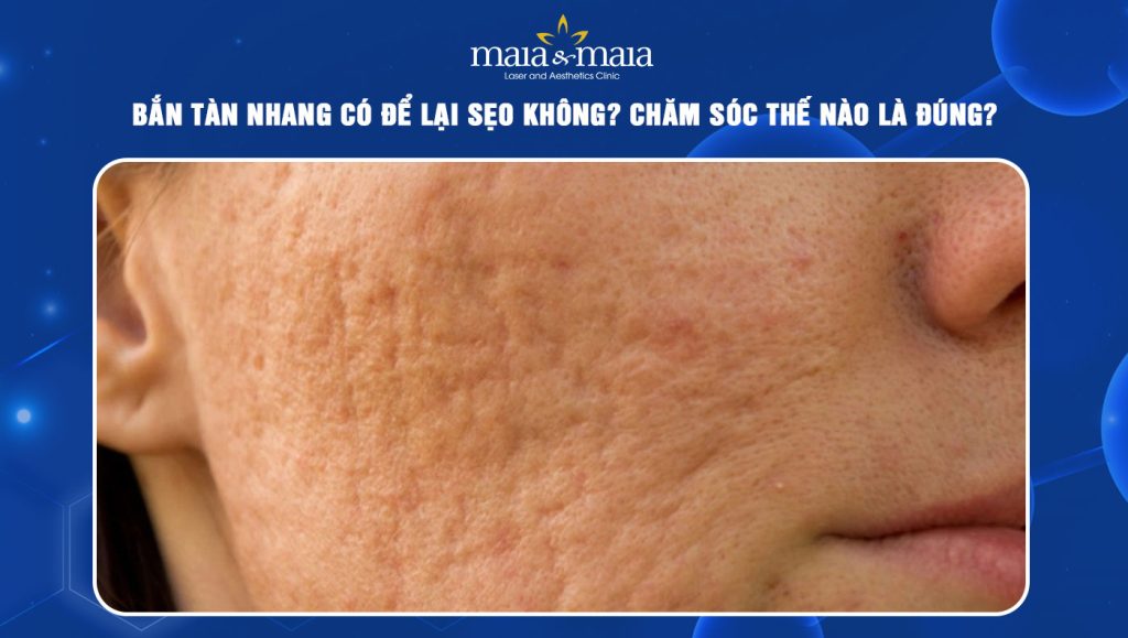 bắn tàn nhang có để lại sẹo không
