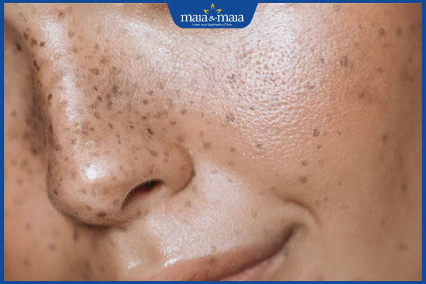 Nám ở mũi là thế nào? Nguyên nhân và cách điều trị 2 bị nám ở mũi