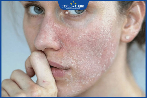 bóc vảy da dễ gây sẹo