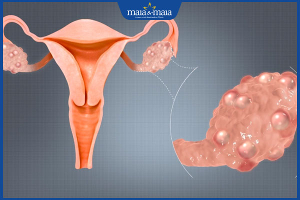 buồng trứng đa nang