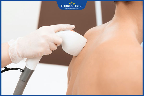 các bước triệt lông lưng