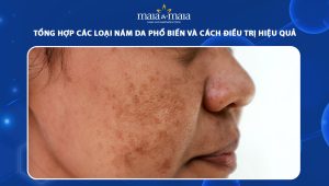 Tổng hợp các loại nám da phổ biến và cách điều trị hiệu quả 117 các loại nám da