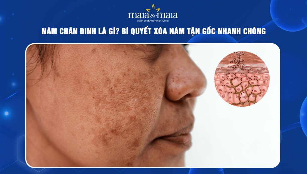 Nám chân đinh là gì? Bí quyết xóa nám tận gốc nhanh chóng 1 cách xóa nám chân đinh
