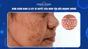 Nám chân đinh là gì? Bí quyết xóa nám tận gốc nhanh chóng 107 cách xóa nám chân đinh