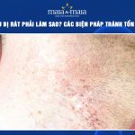 cạo râu bị rát