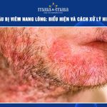 cạo râu bị viêm nang lông