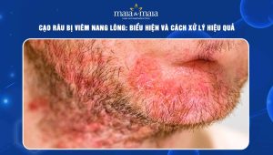 Cạo râu bị viêm nang lông: Biểu hiện và cách xử lý hiệu quả 6 cạo râu bị viêm nang lông