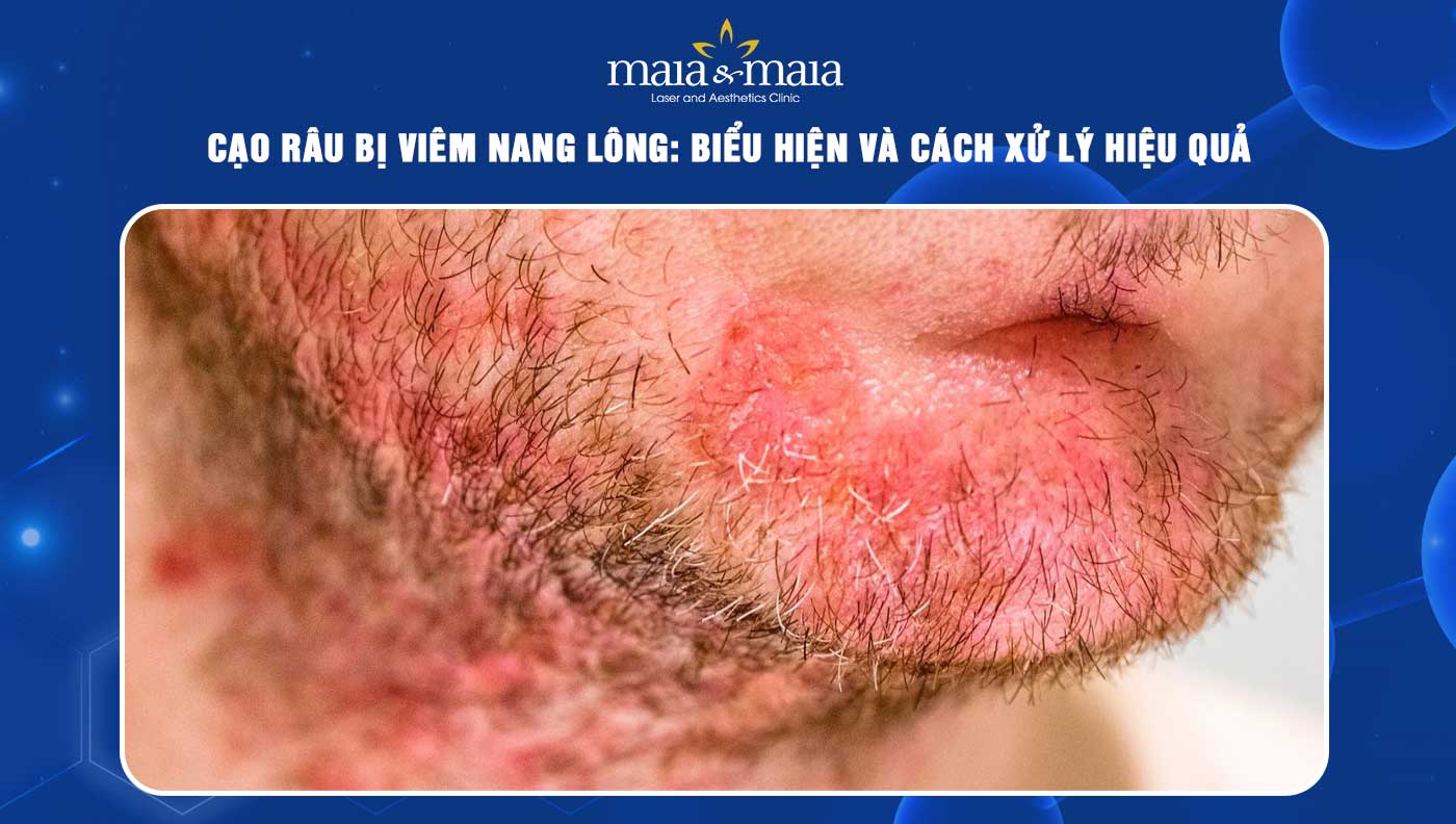 Cạo râu bị viêm nang lông: Biểu hiện và cách xử lý hiệu quả 1 cạo râu bị viêm nang lông