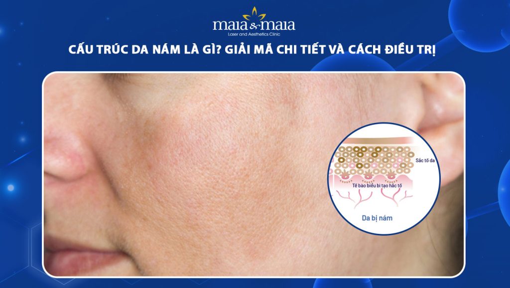 Cấu trúc da nám là gì? Giải mã chi tiết và cách điều trị  1 cấu trúc da nám