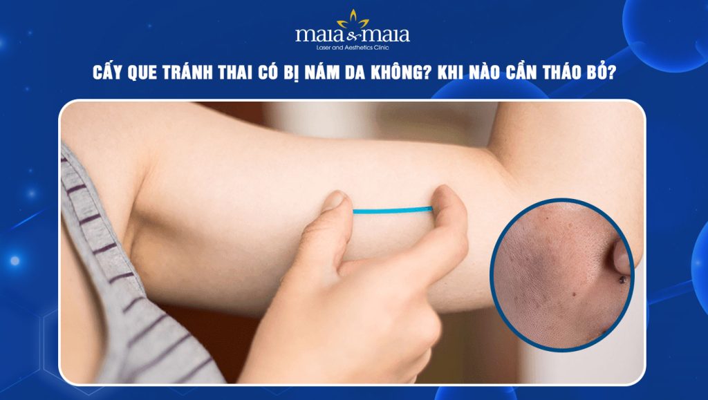 Cấy que tránh thai có bị nám da không? Khi nào cần tháo bỏ?  1 cấy que tránh thai có bị nám da không