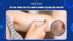 Cấy que tránh thai có bị nám da không? Khi nào cần tháo bỏ?  99 cấy que tránh thai có bị nám da không