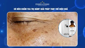 Có nên chấm TCA trị nám? Giải pháp thay thế an toàn và hiệu quả 97 chấm tca trị nám