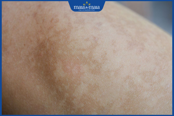 chân có sạm nám