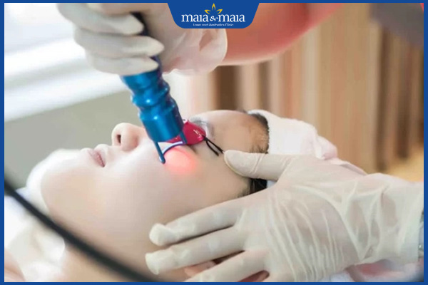 chi phí bắn laser trị tàn nhang