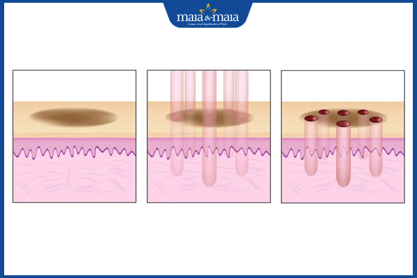 cơ chế của laser