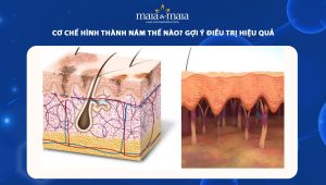 Cơ chế hình thành nám thế nào? Gợi ý điều trị hiệu quả 112 cơ chế hình thành nám