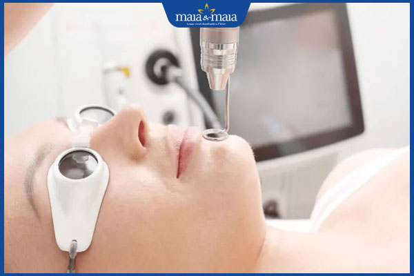 Tổng hợp thông tin về cách trị tàn nhang bằng laser YAG chi tiết nhất! 2 công dụng xóa tàn nhang của laser yag