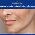 da bị nám nhẹ