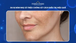 Da bị nám nhẹ có triệu chứng gì? Cách điều trị hiệu quả 56 da bị nám nhẹ