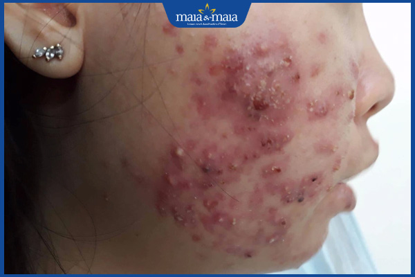 Mài da vi điểm: Lợi ích, đối tượng phù hợp, lưu ý cần ghi nhớ 5 da bị nhiễm trùng