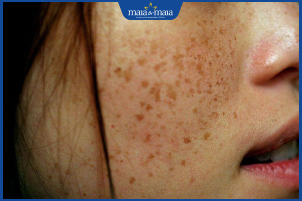 da bị sạm sau laser