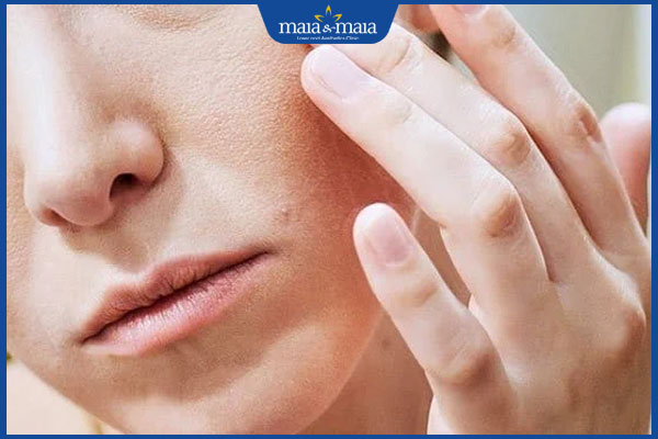 Trị nám vào mùa đông có lợi ích gì? Giải pháp xóa nám hiệu quả 2 da khô