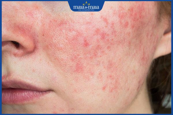 da mỏng yếu dễ thâm sạm sau bắn tàn nhang