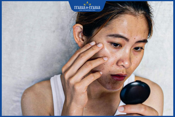 Bấm huyệt chữa nám da hiệu quả ra sao? Các huyệt đạo cần ghi nhớ 2 da xám xịt