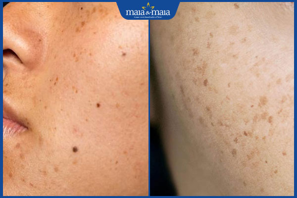 dac diem chung cua tan nhang va not ruoi