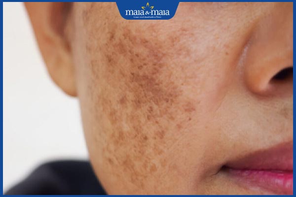 Nám cánh bướm có đặc điểm gì? Điều trị và phòng ngừa thế nào? 2 đặc điểm nám cánh bướm