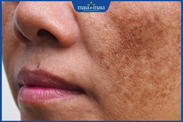 Nám mảng: Nguyên nhân, dấu hiệu và cách điều trị hiệu quả 2 đặc điểm nám mảng