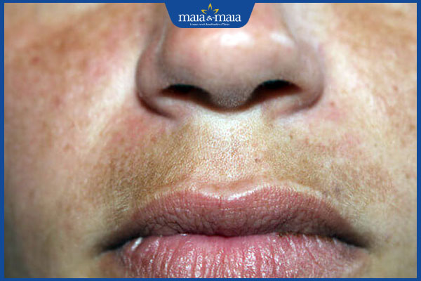 đặc điểm nám râu