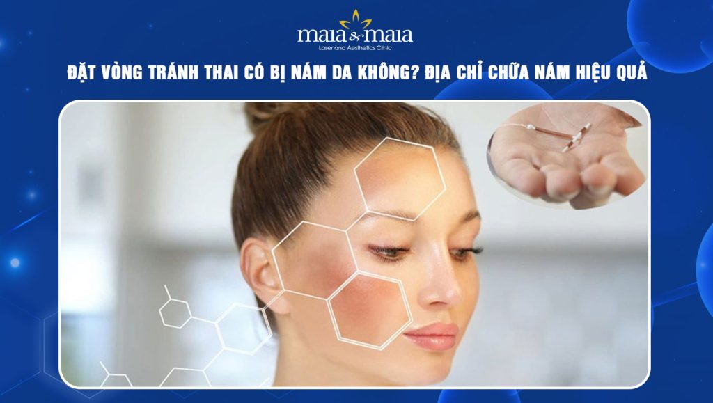 đặt vòng tránh thai có bị nám da không