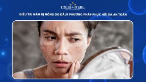 Điều trị nám bị hỏng do đâu? Phương pháp phục hồi da an toàn 112 điều trị nám bị hỏng