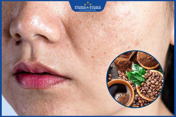 điều trị nám da với cà phê