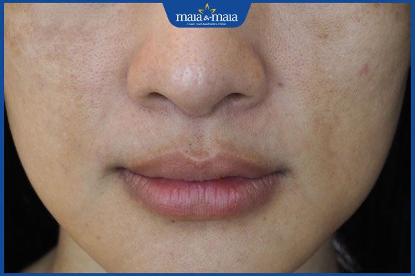 đốm nám li ti quanh miệng