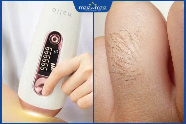 dùng máy triệt lông ngón tay cá nhân