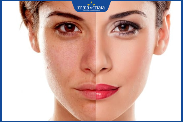 hiệu quả lột da chữa nám